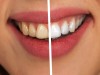 زرد شدن دندان‌ها | چرا مسواک کافی نیست؟